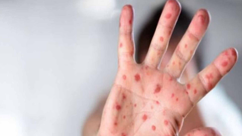 TƏBİB qızılca ilə bağlı valideynlərə xəbərdarlıq edib