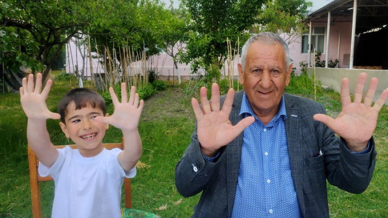 6 barmaqlı uşaq: “Barmaqlarımdan xoşum gəlir, bunlardan heç kimdə yoxdur”