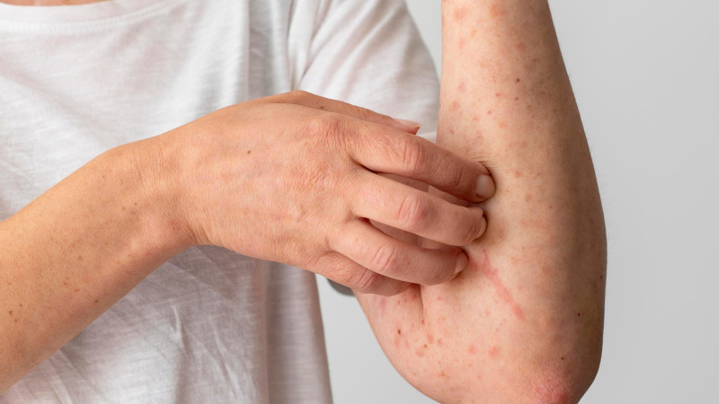 Rumıniyada qızılca epidemiyasının yayılıb