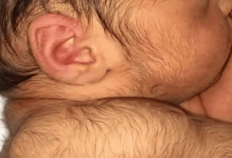 İspaniyada əczaçılıq şirkətinin səhvi üzündən körpələrdə “canavar adam sindromu” inkişaf edib