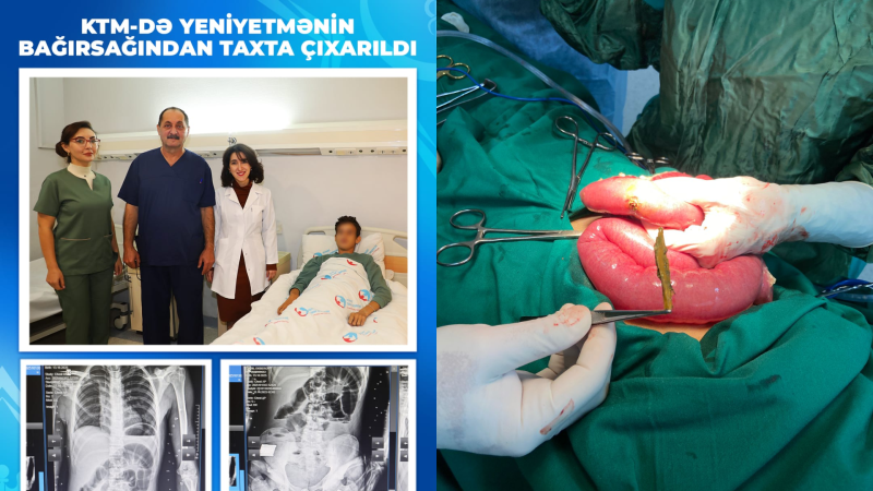 17 yaşlı yeniyetmənin bağırsağından taxta parçaları çıxarıldı