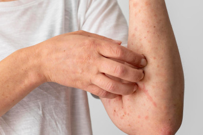 Rumıniyada qızılca epidemiyasının yayılıb