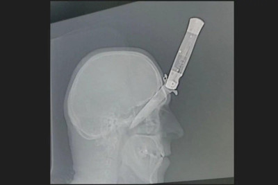 Rusiyada həkimlər başına bıçaq batan şəxsin həyatını xilas ediblər