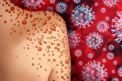 Meymunçiçəyi virusundan necə qorunmaq olar? – İNFEKSİONİSTDƏN AÇIQLAMA