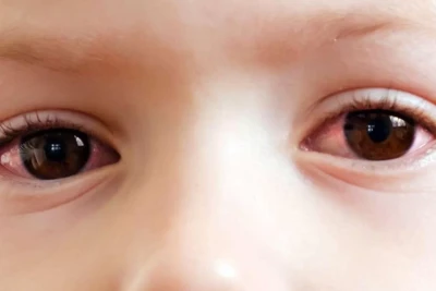 Hər gün eyni yeməyi yeyən uşaq kor oldu