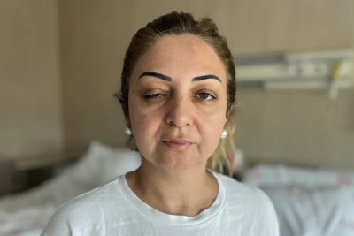 3 qadın botoksdan sonra xəstəxanaya yerləşdirildi: Danışmaqda və görməkdə çətinlik çəkirlər